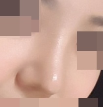 코재수술 후기
