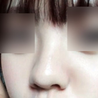 콧볼축소 후기