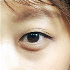 쌍꺼풀(자연유착) 후기