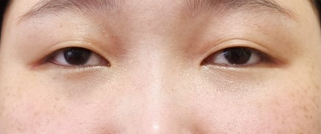 쌍꺼풀(절개) 후기
