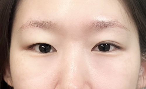 쌍꺼풀(자연유착) 후기