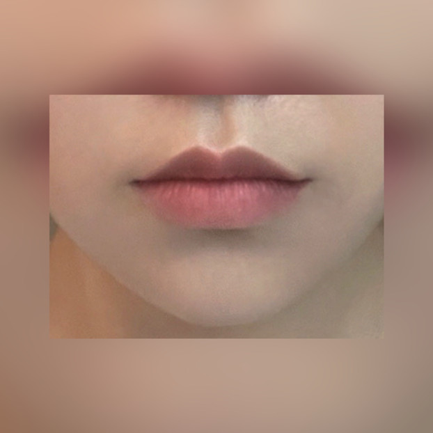 큐피트라인성형 후기