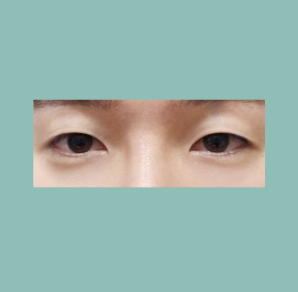 쌍꺼풀(자연유착) 후기