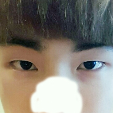 쌍꺼풀(절개) 후기