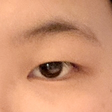 쌍꺼풀(절개) 후기