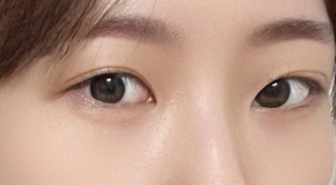 밑트임 후기