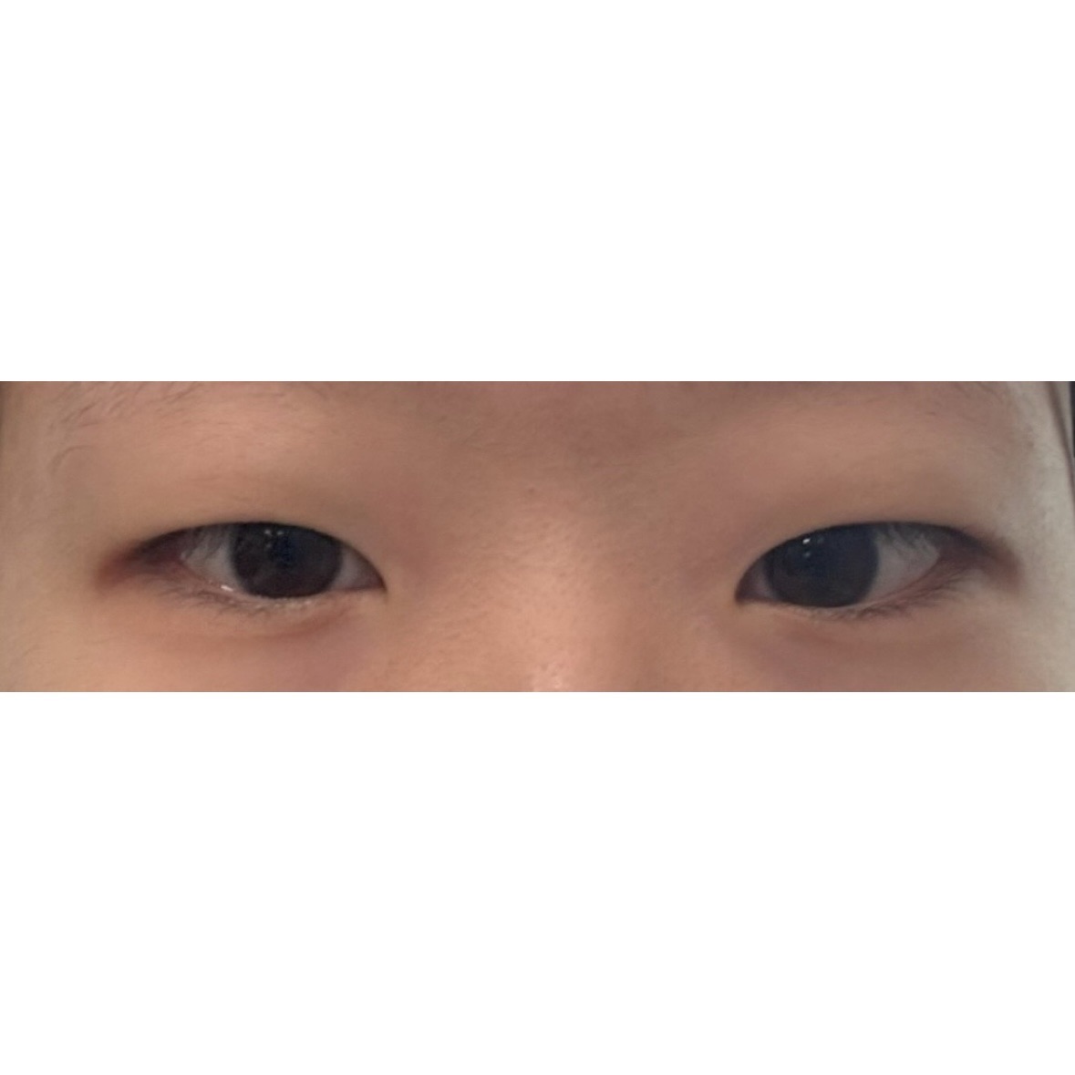 쌍꺼풀(절개) 후기