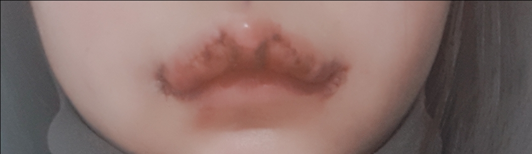 입꼬리성형 후기
