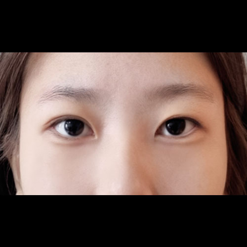 쌍꺼풀(자연유착) 후기