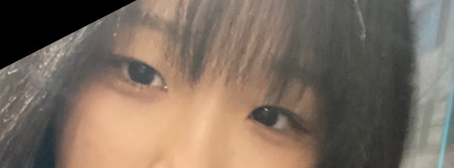쌍꺼풀(절개) 후기