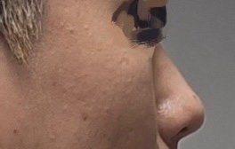 코끝(보형물) 후기