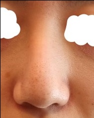 비중격만곡증수술 후기
