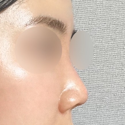 코끝수술 후기
