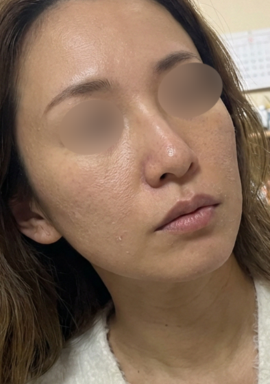 리쥬란힐러 후기