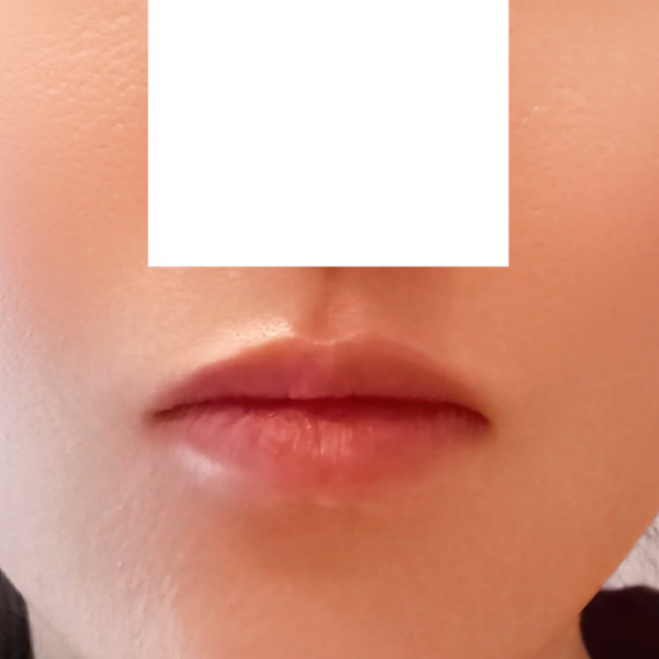 입꼬리성형 후기