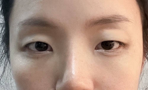쌍꺼풀(자연유착) 후기