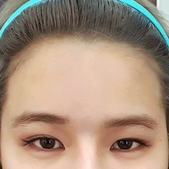 눈재수술 후기
