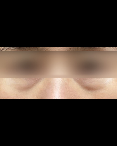 눈밑지방재배치 후기