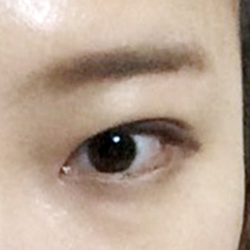 눈재수술 후기