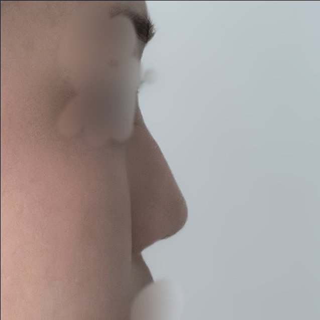 콧대(보형물) 후기