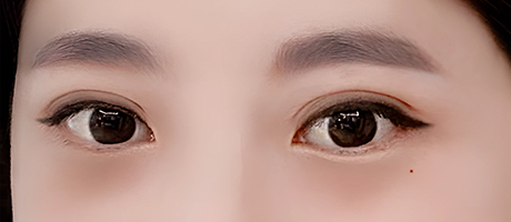 눈재수술 후기