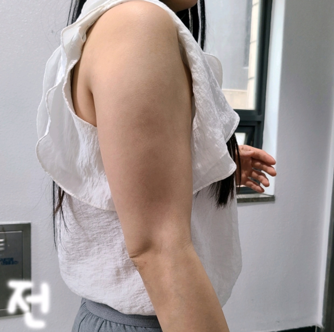 팔지방흡입 후기