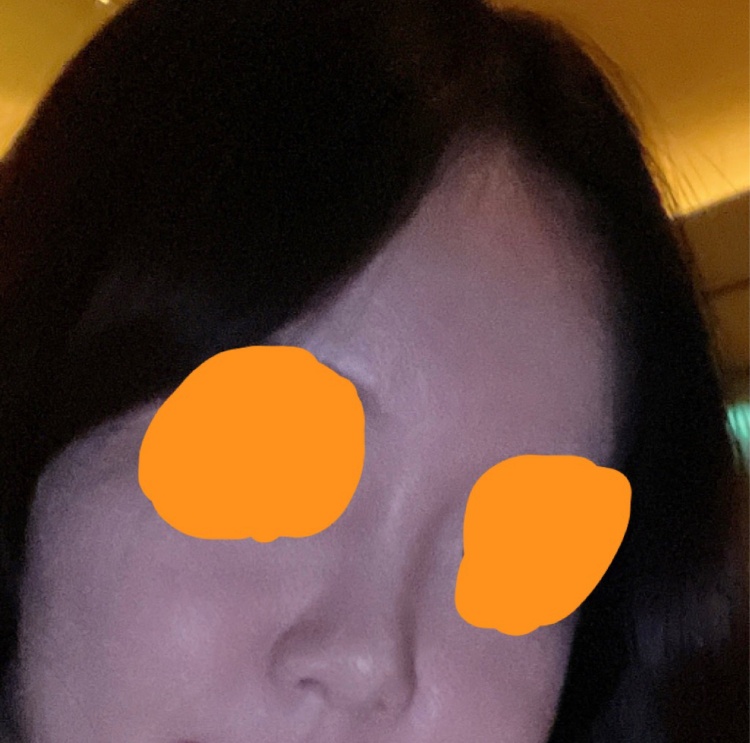 코재수술 후기