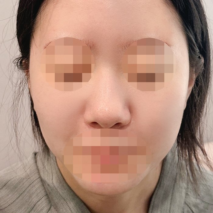 코재수술 후기