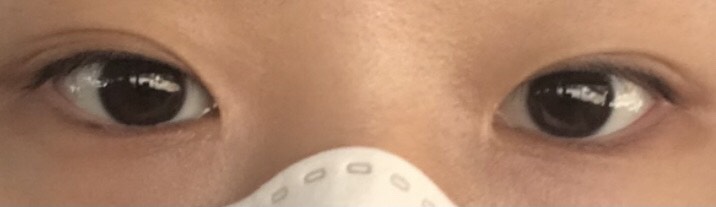 쌍꺼풀(절개) 후기