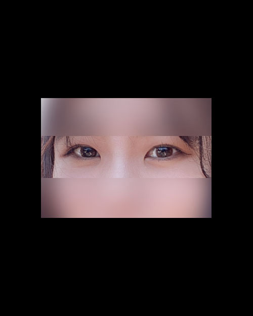눈재수술 후기