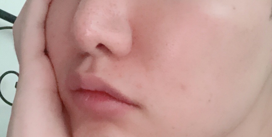 입꼬리성형 후기