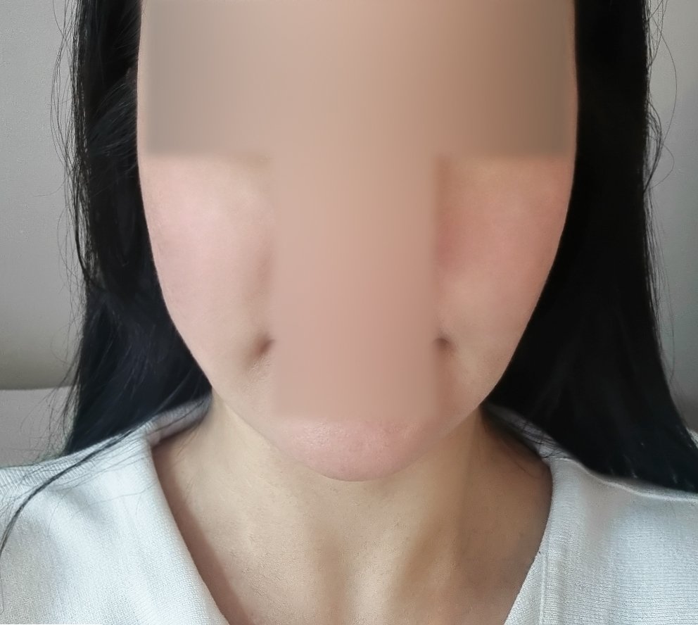 실리프팅 후기