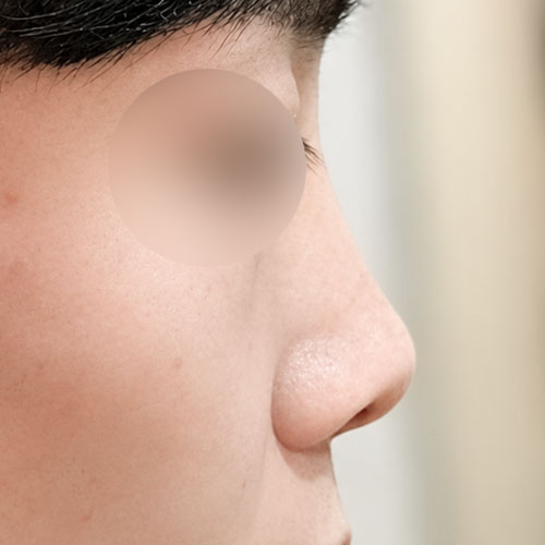 코재수술 후기