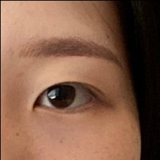 눈매교정 후기