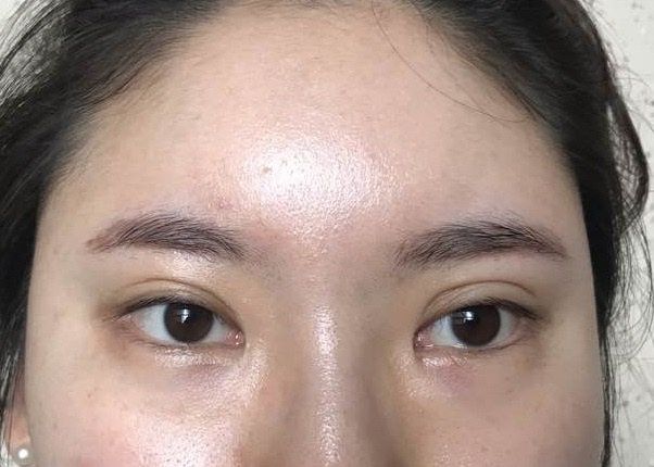 눈재수술 후기