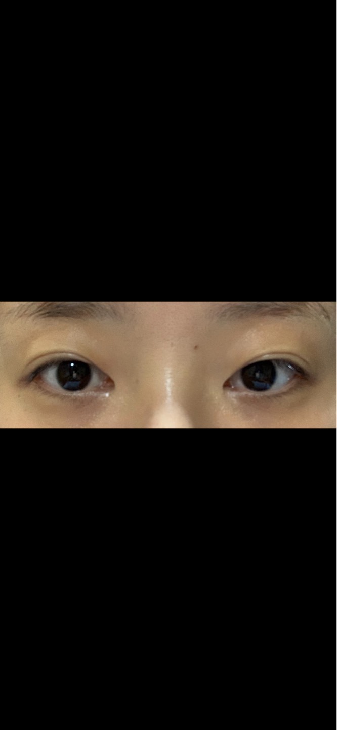 쌍꺼풀(절개) 후기