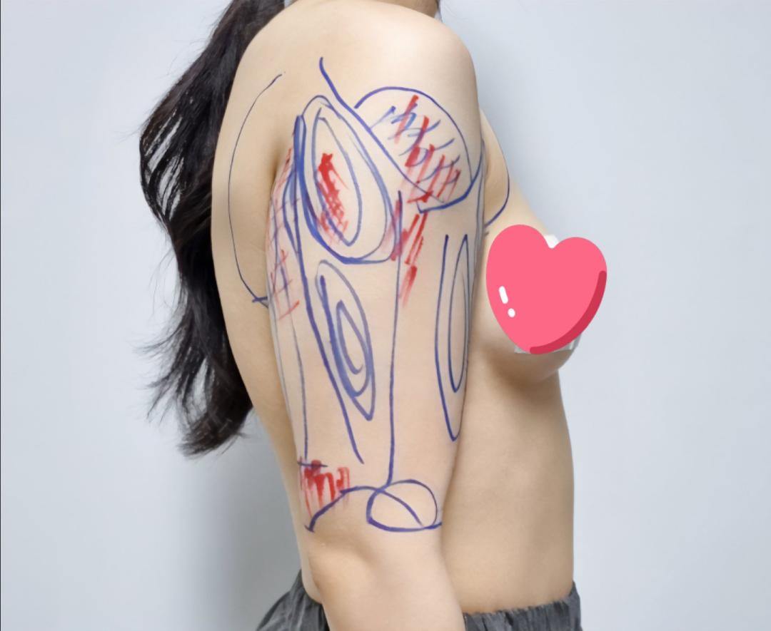 팔지방흡입 후기