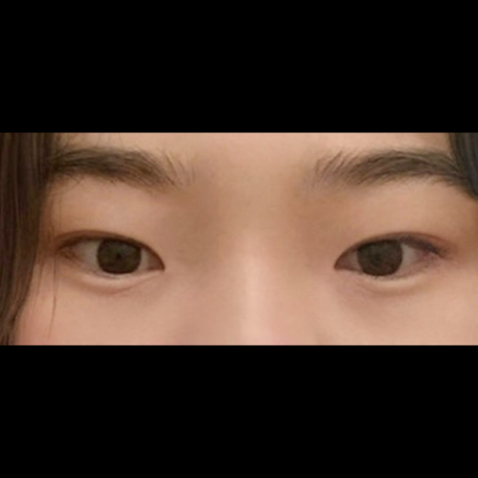 눈재수술 후기