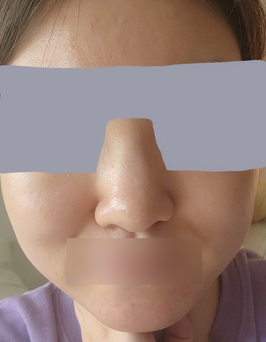 콧대(보형물) 후기