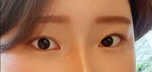 코재수술 후기