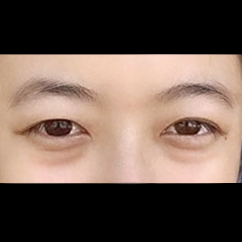 쌍꺼풀(절개) 후기