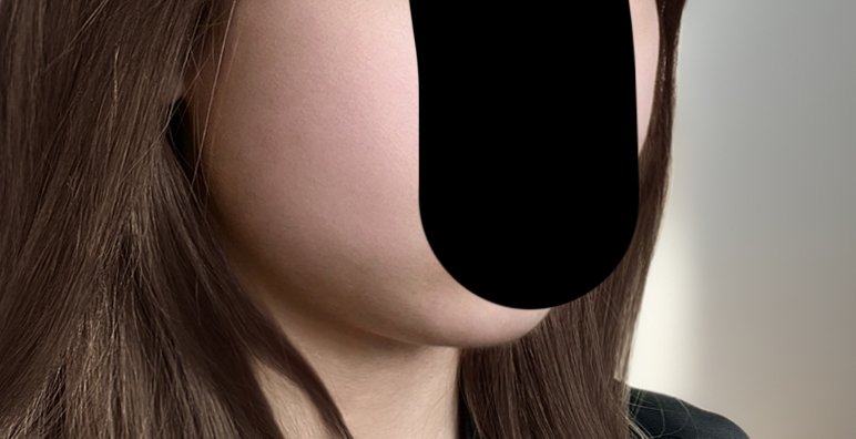 윤곽주사 후기