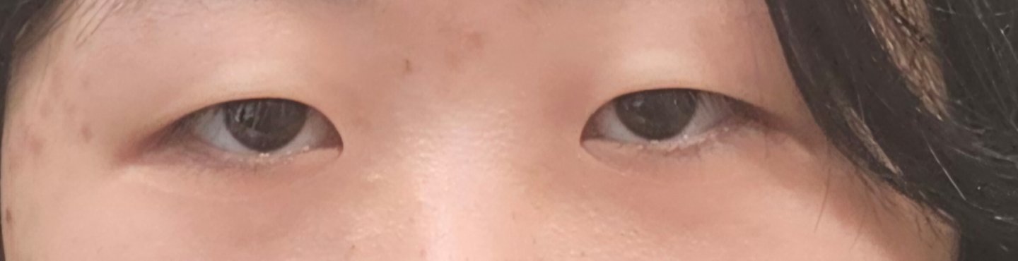 쌍꺼풀(절개) 후기