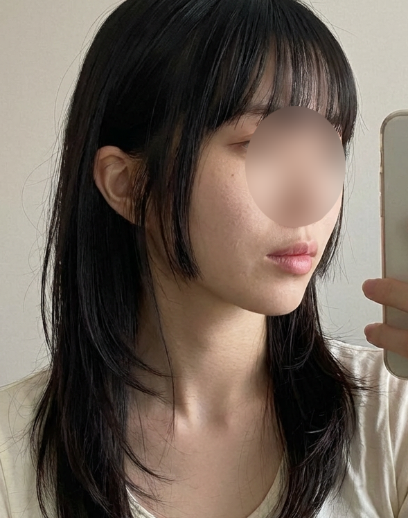 리쥬란힐러 후기