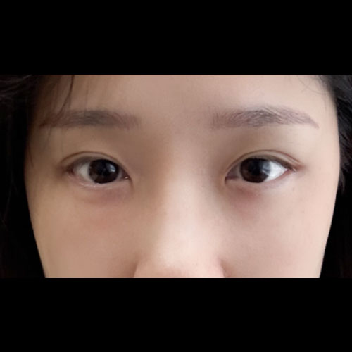 쌍꺼풀(자연유착) 후기