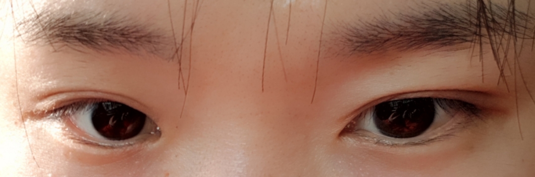 쌍꺼풀(매몰) 후기