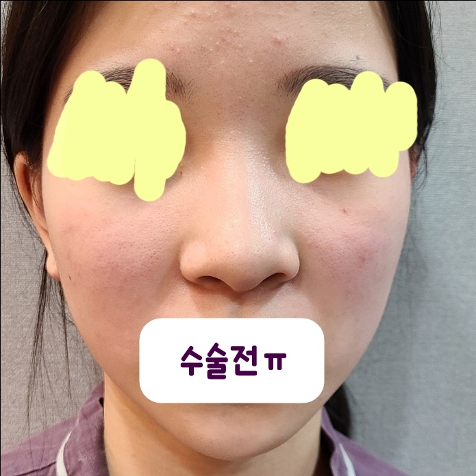 콧대(보형물) 후기