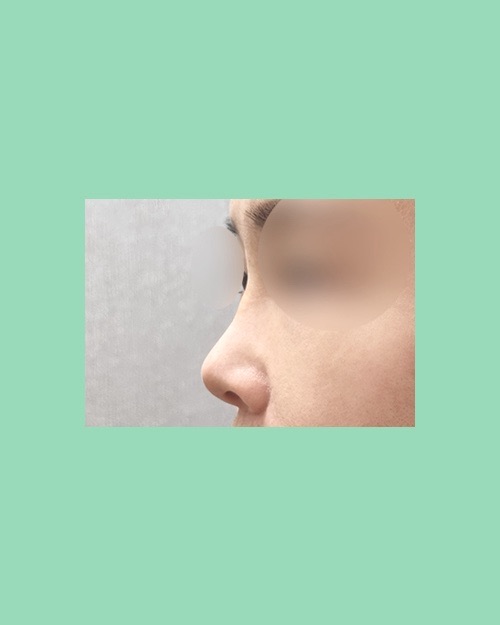 코재수술 후기