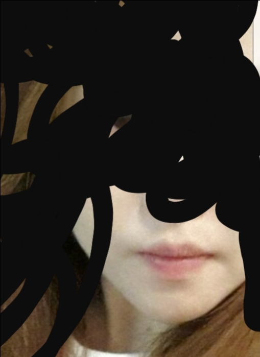 입꼬리성형 후기