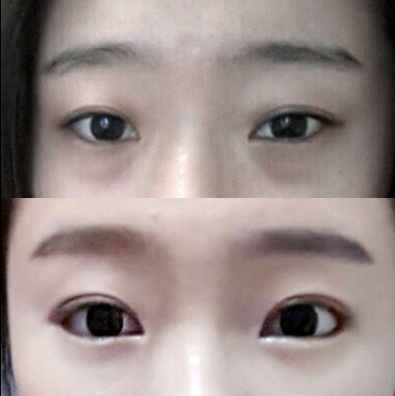 쌍꺼풀(절개) 후기
